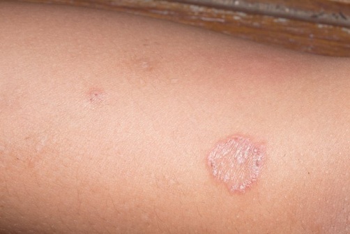 Δέρμα εξανθήματα και προκαλεί Ringworm