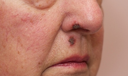 Δερματικά εξανθήματα και προκαλεί Impetigo