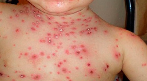 Δερματικά εξανθήματα και προκαλεί Chicken Pox