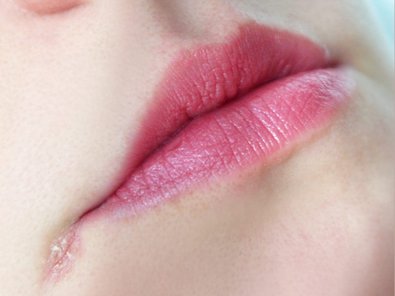 Φυσικές θεραπείες για ραγισμένες γωνίες στόματος