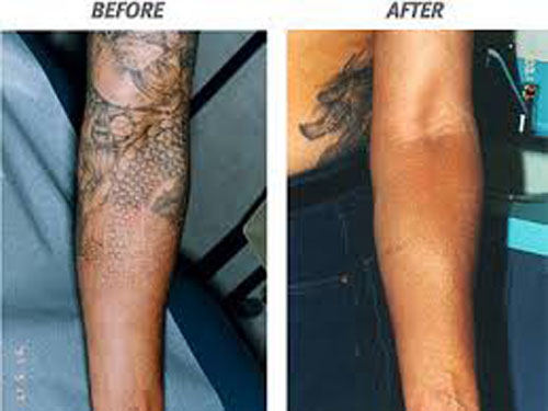 Puolihihan laser -tatuoinnin poisto
