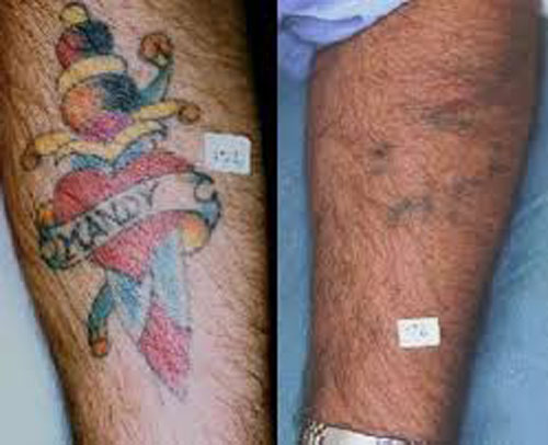 Color Tattoo Removal Laser Treatment