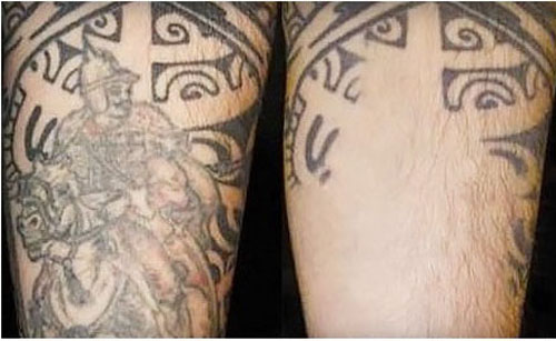Μερική αφαίρεση τατουάζ λέιζερ