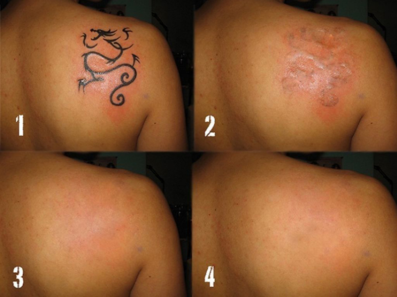 Θεραπείες αφαίρεσης τατουάζ με λέιζερ