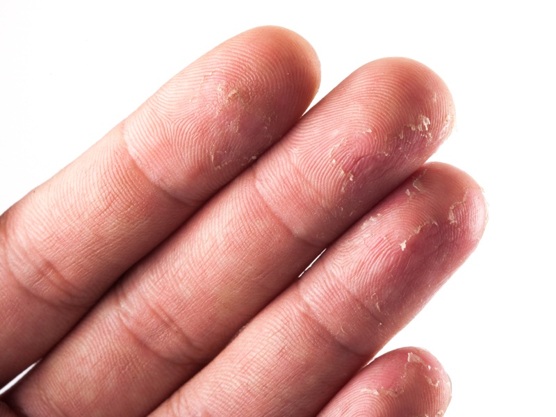 Αρχική θεραπεία για να απαλλαγείτε από το ξεφλούδισμα των δακτύλων σας