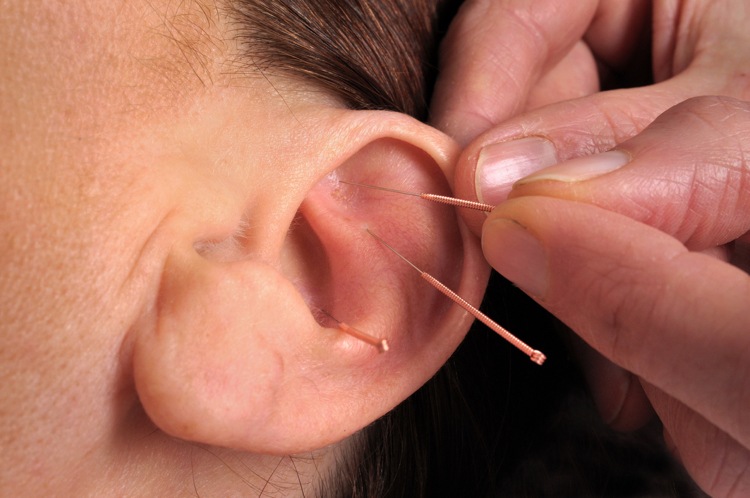 Gå ner i vikt med akupunktur i öronnålarna