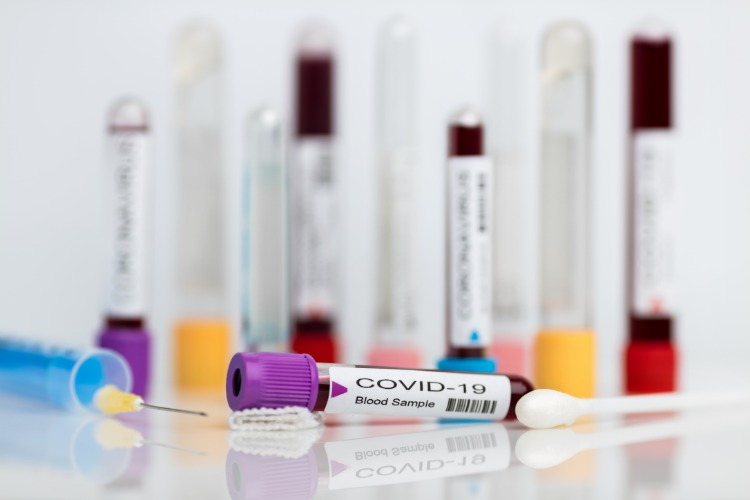 laboratorium covid 19 med blod i burkar