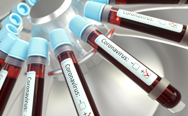 flera blodprov med positivt covid-19-resultat i laboratoriet