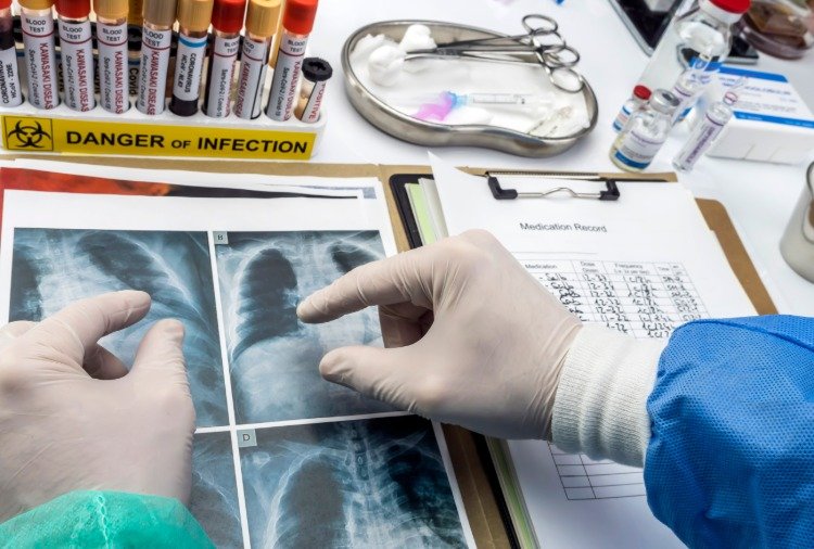 röntgenstrålar av spädbarnslungor på grund av coronavirus i spädbarnsstudier