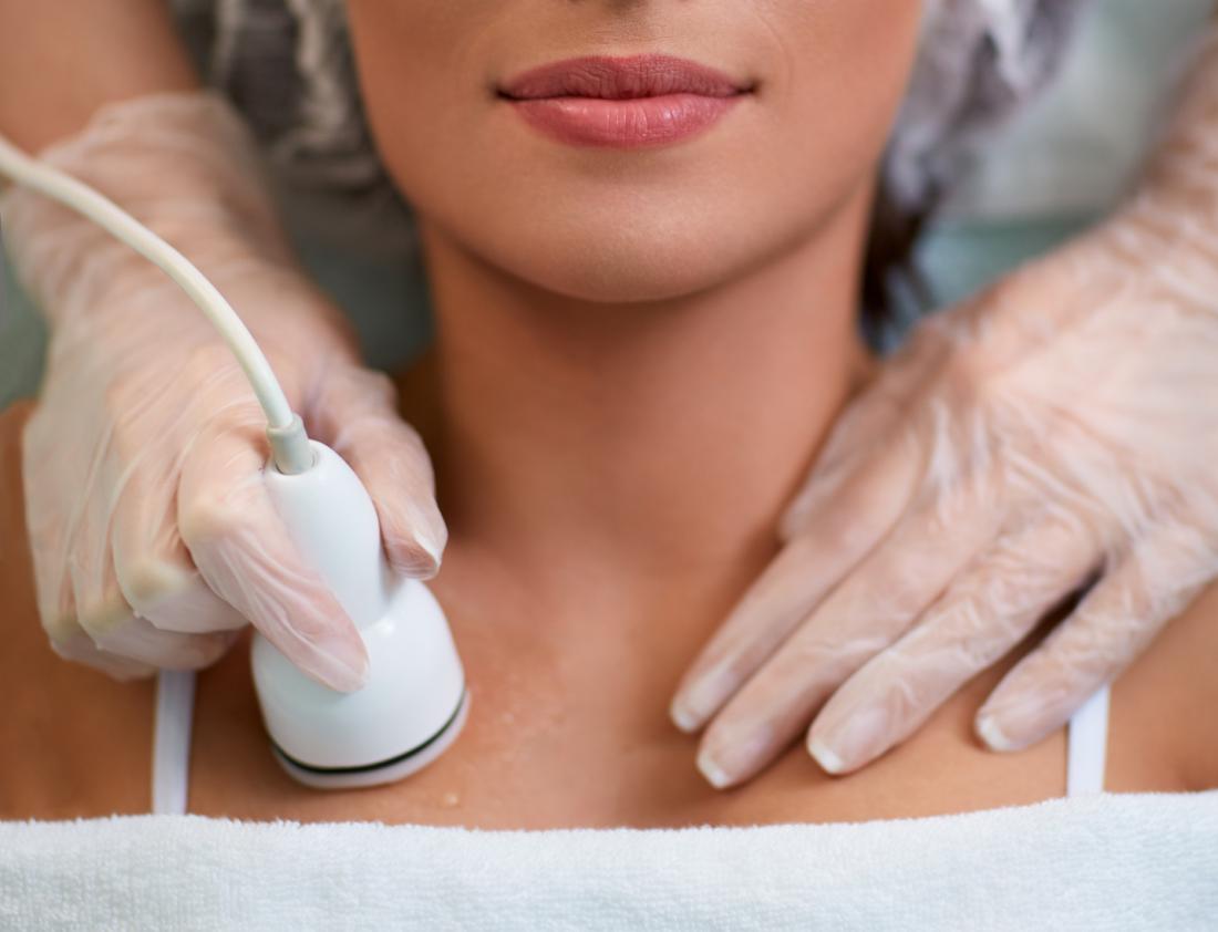 Ta bort bristningar bröst kostar laser behandling erfarenhet varaktighet