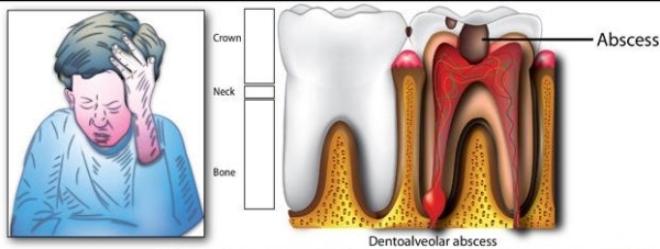 Orsakar tandvärk-kariesbildning-nerver inflammation tandkött