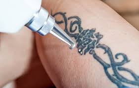 Laser για την αφαίρεση μόνιμου τατουάζ