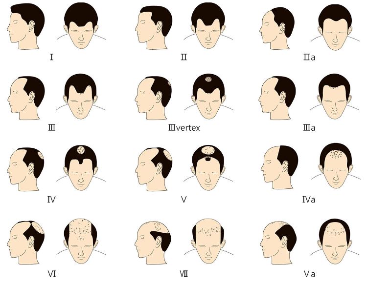 frisyrer med avtagande hårfäste för män hårklippning hårlinje oklar nordwoood klassificering