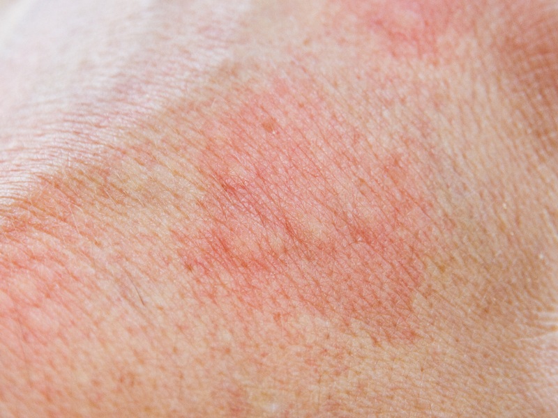 Λάβετε άμεση ανακούφιση από την αλλεργία στο δέρμα