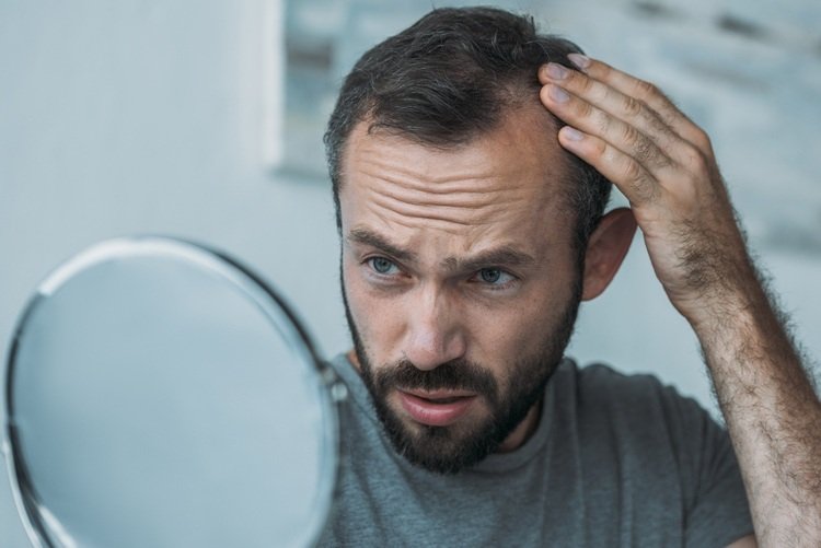 Man med en avtagande hårlinje påverkad av håravfall