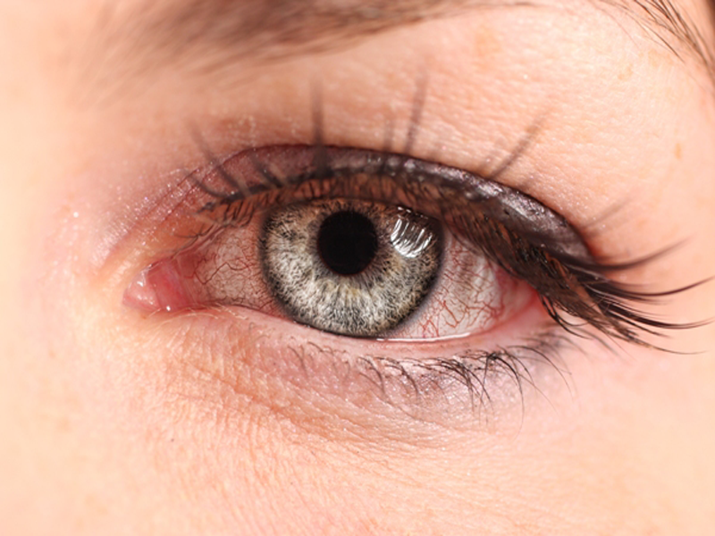 σπιτικές θεραπείες για το ροζ μάτι
