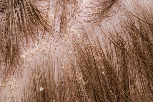 θεραπείες σπα μαλλιών για μαλλιά πιτυρίδας