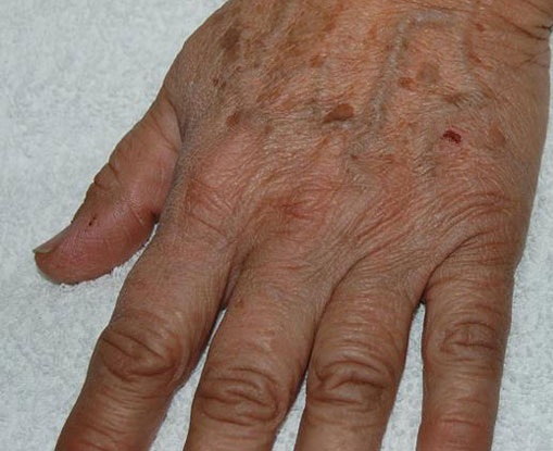 Χημικό Peel για την αφαίρεση των ρυτίδων από τα χέρια