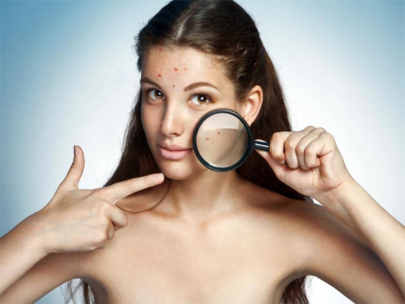 Pimple -hoito rasvaiselle iholle
