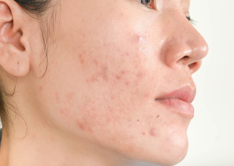 Orsaker till röda fläckar i ansiktet på grund av akne inkluderar hormonella förändringar