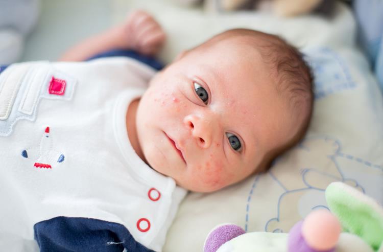 Utslag hos barn och spädbarn och röda fläckar i ansiktet bör undersökas av läkaren