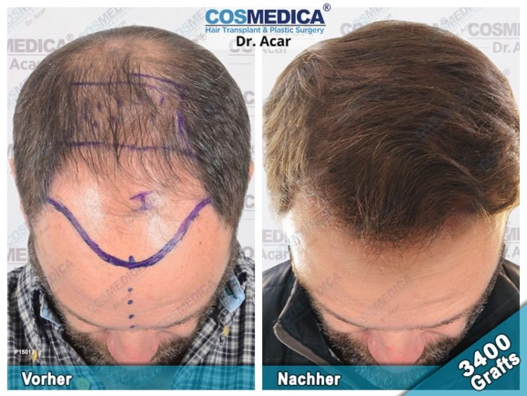 Hårtransplantation avtagande hårfäste av Dr Acar på kliniken i Turkiet innan efter jämförelse