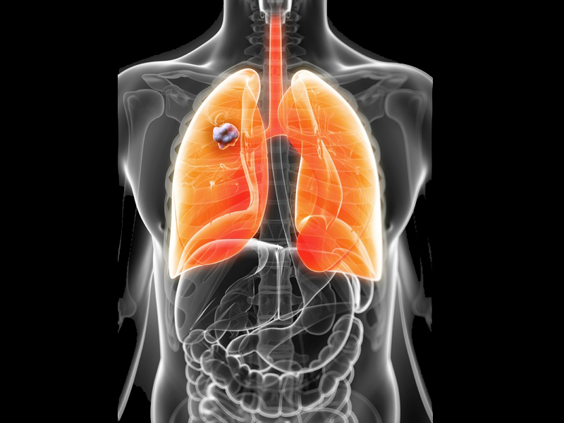 Keuhkosyövän oireet ja syyt