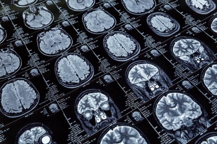 datortomografi av hjärnan vid demens eller Alzheimers sjukdom