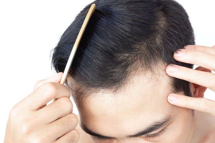 Med Neo Fue -hårtransplantation är tillväxttakten för det implanterade håret högre
