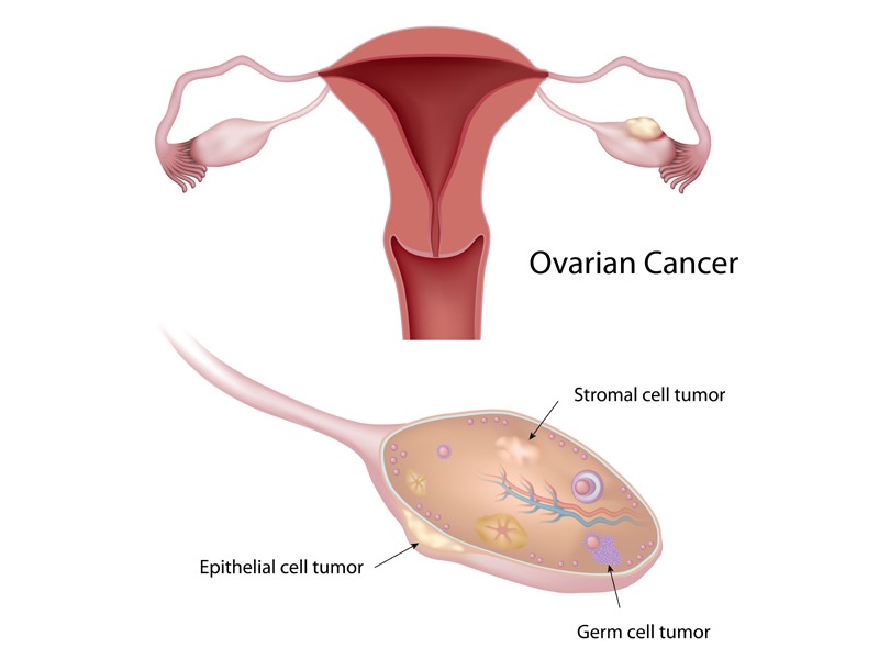 Καρκίνος των ωοθηκών κατά τη διάρκεια της εγκυμοσύνης
