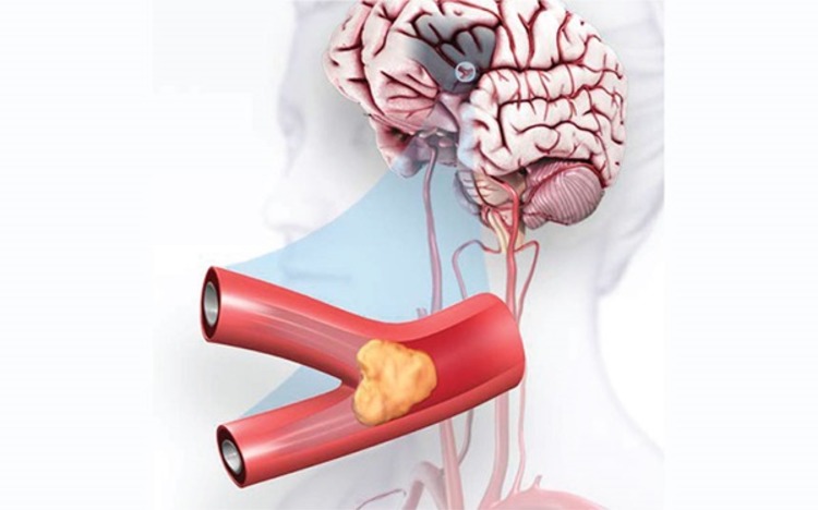 Ischemisk stroke förhindrar igensättning av artären som leder till hjärnan