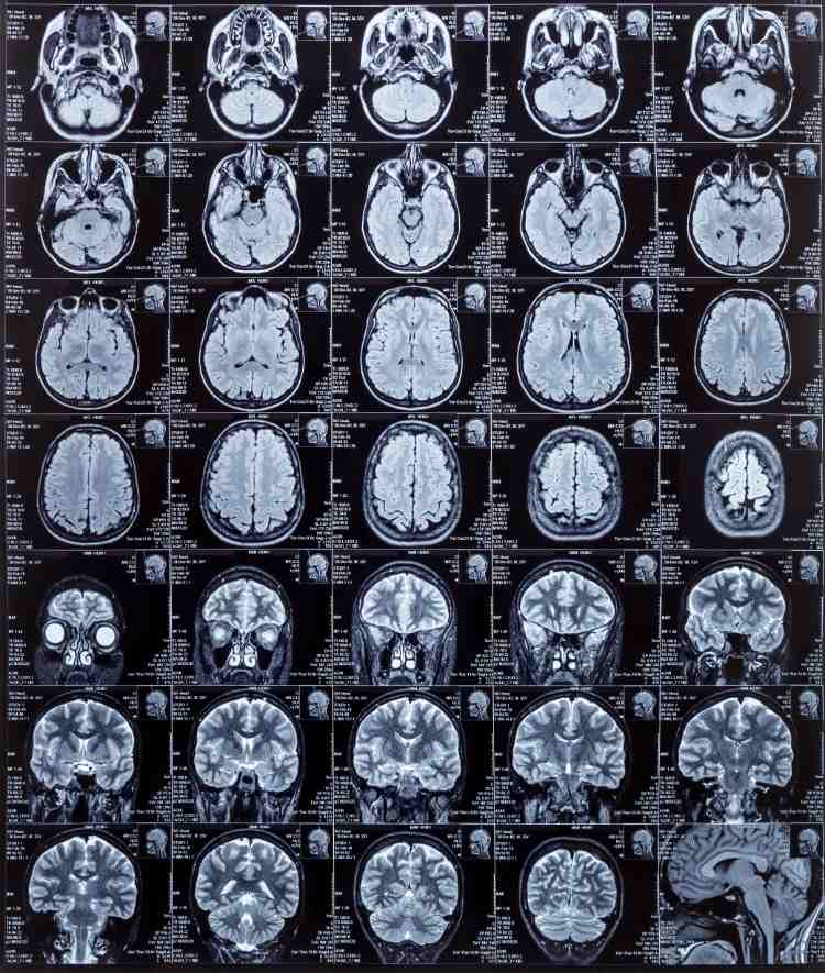 Magnetisk resonansavbildning av hjärnan vid en hemorragisk stroke