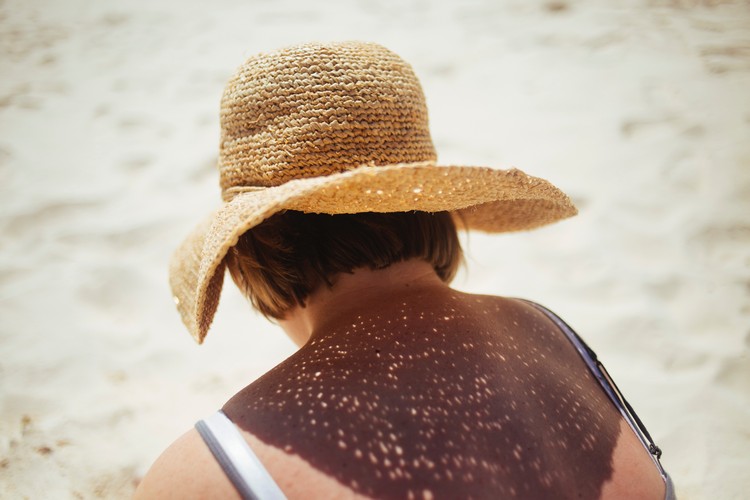 psoriasis sommar behandla solskydd