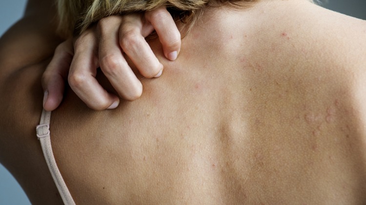 Kvinnlig person kliar kliande hud på ryggen på grund av svart fröolja effekt