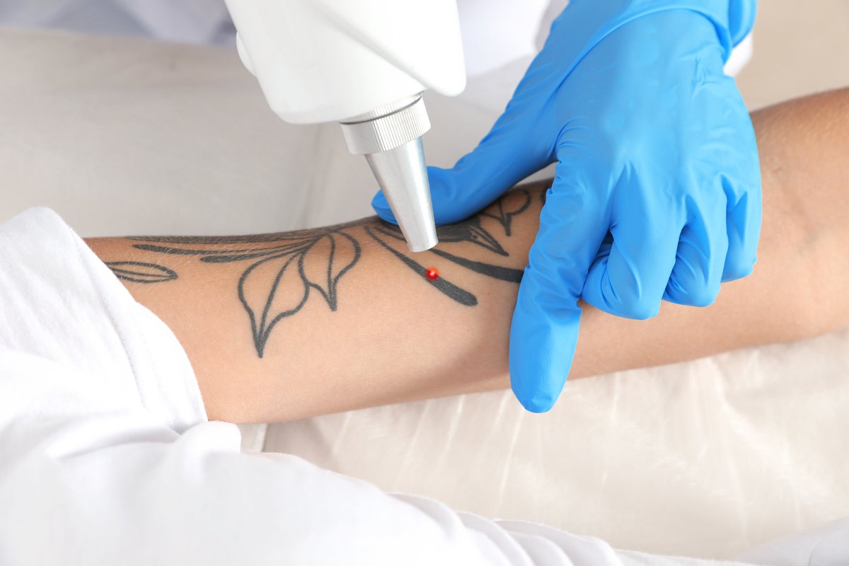 Tatueringsborttagningsmetoder Laserborttagningskostnader Fjärilstatuering