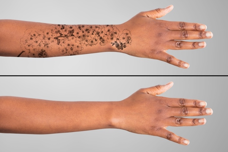 Tatueringsborttagningsmetoder tatueringsborttagning peeling hand tatuering blommor