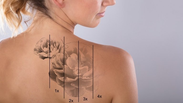 Få tatuering borttagna Laser Tattoo borttagning varaktighet smärta