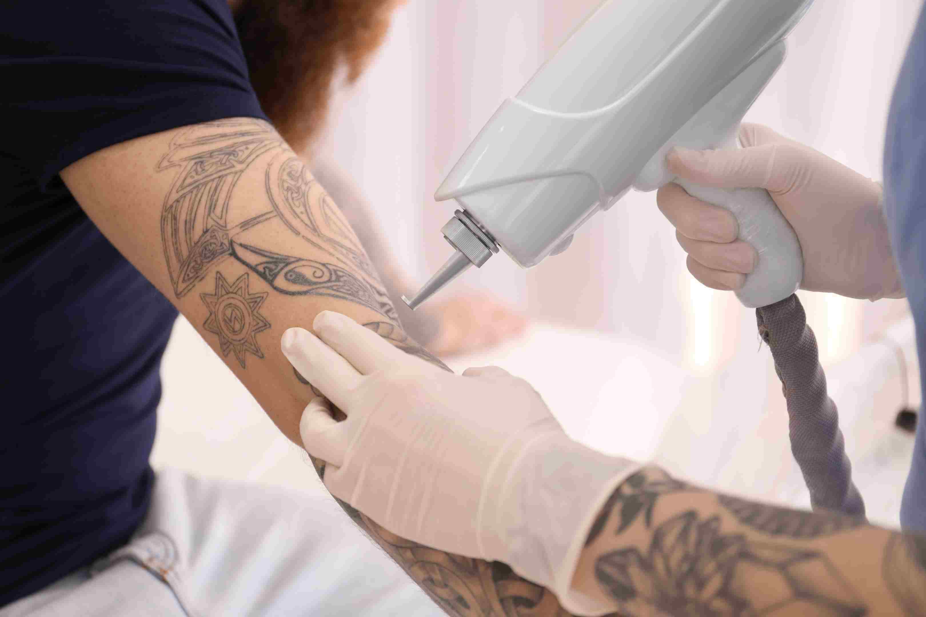Tatueringsborttagningsmetoder tatueringsborttagning kirurgi erfarenhet