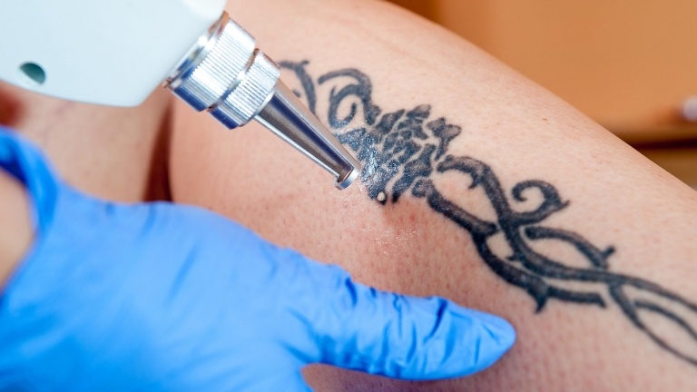 Borttagning av tatueringar Lasertatuering Borttagning Smärta Kostnad