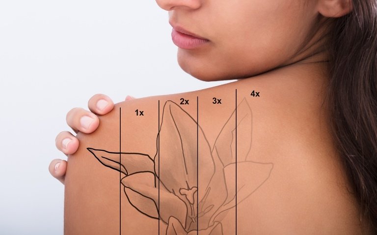 Tatueringsborttagningsmetoder tatueringsborttagning hudskalning blomma tatuering axel