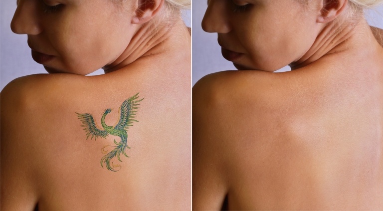 Tatueringsborttagningsmetoder Phoenix tattoo axel kvinnor tatueringstrender
