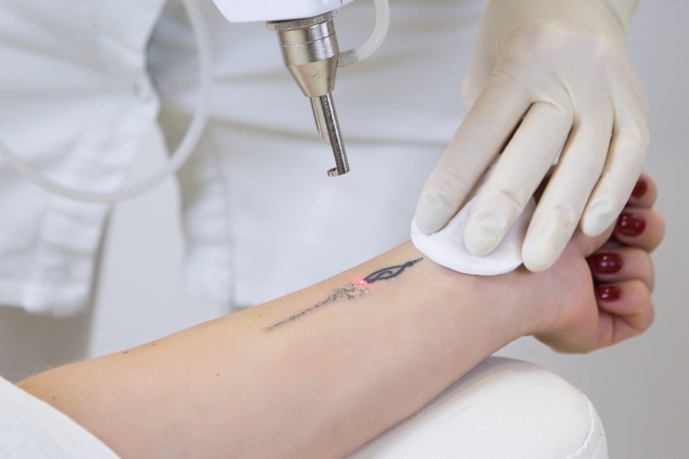 Tatueringsborttagningsmetoder Laserborttagning kostar smärta