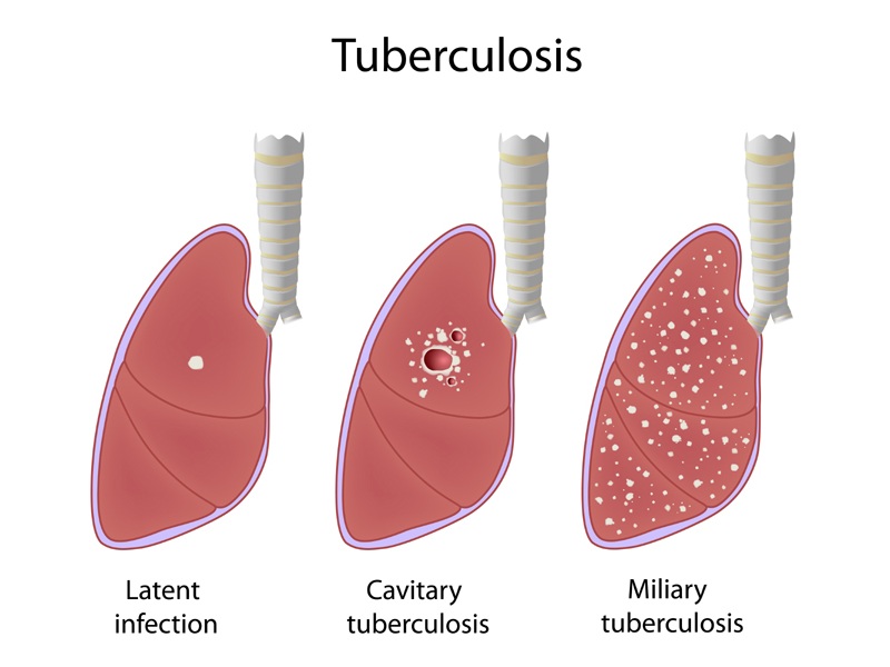 Tuberkuloosi (tb) Oireet ja syyt