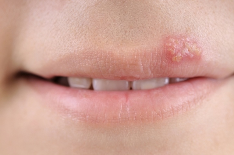 De små blåsorna på huden är typiska för munsår och andra typer av herpes